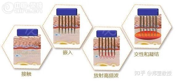 最近很火的黃金微針，聽說可以讓痤瘡痘坑永久退散了？！