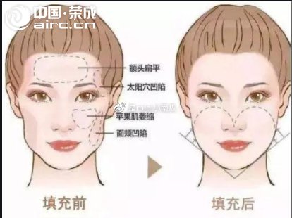 抗衰科普：自體脂肪豐臉做完以后，臉會再下垂嗎？