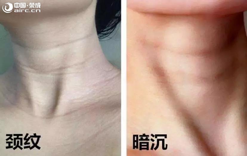 一條頸紋老10歲，就算你有baby的臉，也看上去不年輕啊！